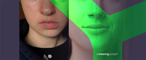 Asymmetrical Jaw And Chin Causes And How To Fix It Naturally Ach