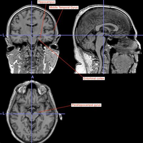 Mri Of An Nc Mci An Ad Patient These Are Images Of Mri Scans From