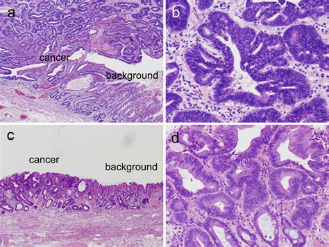 Figure 5 From Gastric Adenocarcinoma Of The Fundic Gland Type After