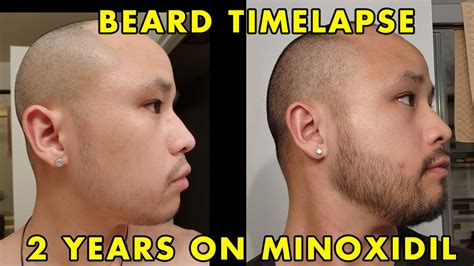 2 Year Timelapse Of My Minoxidil Asian Beard Journey Youtube