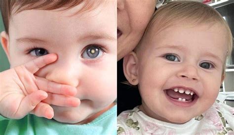 O que é o retinoblastoma câncer que afeta a filha de Tiago Leifert