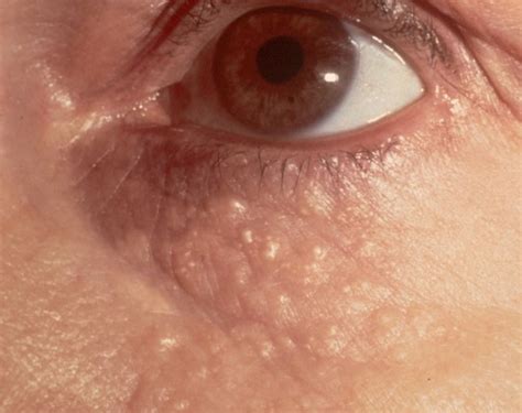 Red Bumps Under The Eyes Causes And Effective Treatments Under Bump