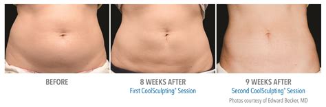 Farmington Mi Coolsculpting Bloomfield Hills Freeze Fat Ageless Image