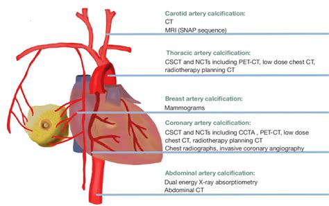 The Anatomical Locations Of The 5 Types Of Vascular Calcification As