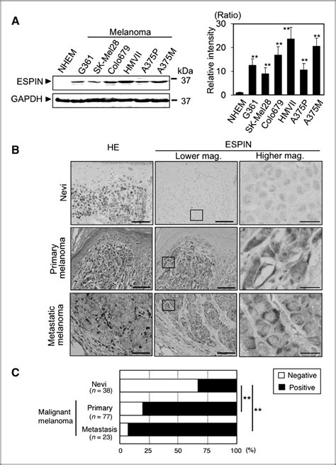 Espin Expression In Human Melanoma Cell Lines And Melanoma Tissues A