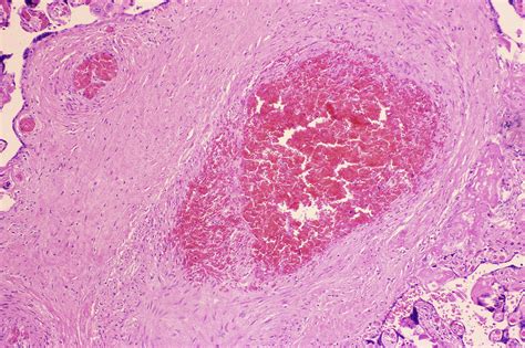 Fetal Thrombotic Vasculopathy Surgical Pathology Clinics