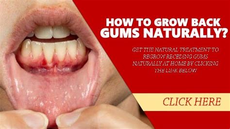 How To Grow Back Gums Naturally 1