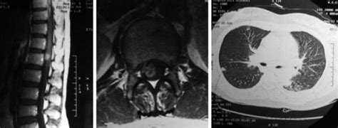 Intradural Extramedullary Malignant Tumors Neupsy Key