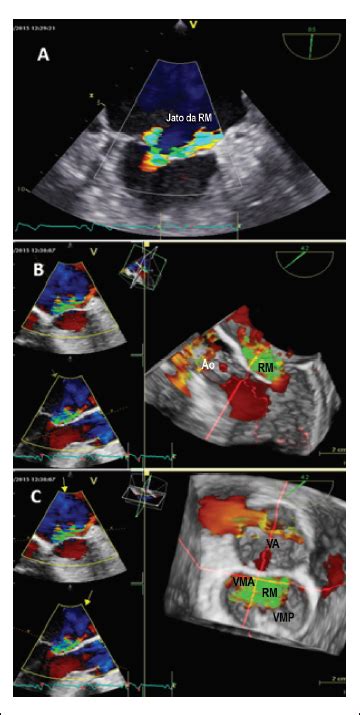 SciELO Brasil Ecocardiografia Tridimensional Revela O Verdadeiro