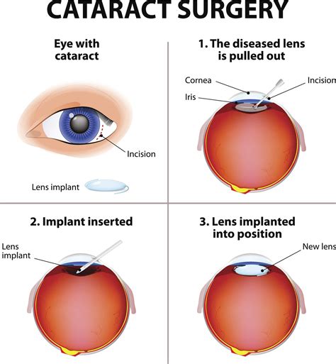 Cataract Surgery Portland Or The Eye Clinic P C