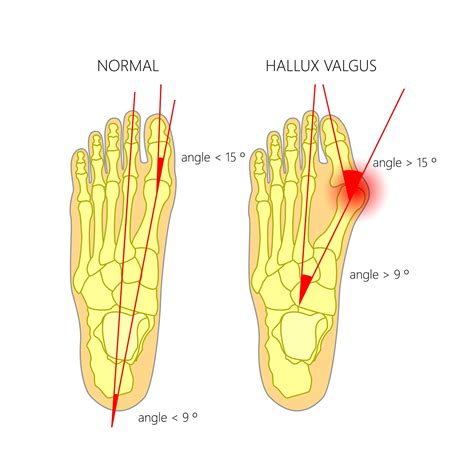 Hallux Valgus Interphalangeus Causes, and Best Treatment