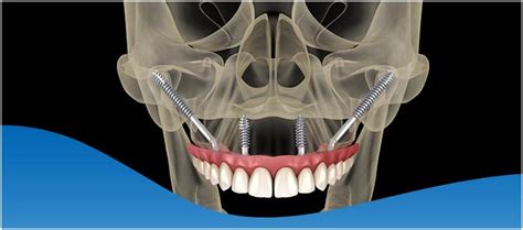 Zygomatic Arch Implants