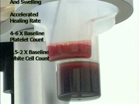 Prp Surgical Demonstration Platelet Rich Plasma For Tennis Elbow