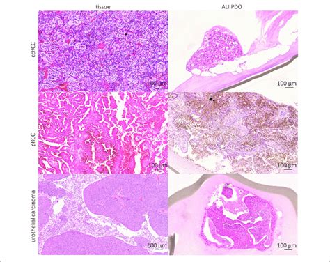 Kidney Tumor Ali Pdos Resemble Tumor Of Origin Histologically Ihc