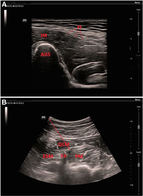 Comparison Between Ultrasound Guided Suprainguinal Fascia Iliaca Block And Anterior Quadratus