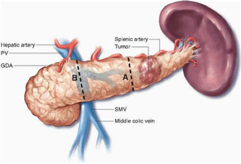 Distal Pancreatectomy Oncohema Key