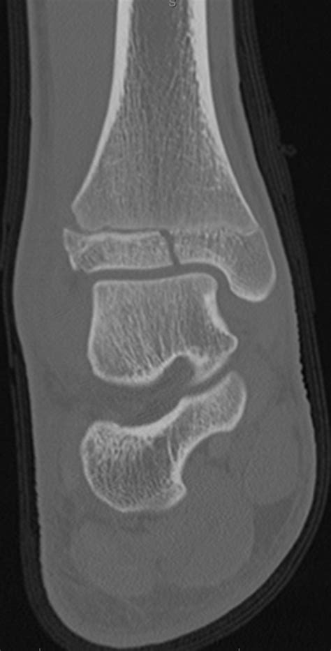 Triplane Fracture Radiology Case Radshare Net