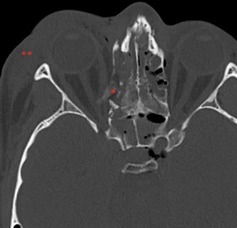 Computed tomography scan showing right-sided proptosis -comminuted ...