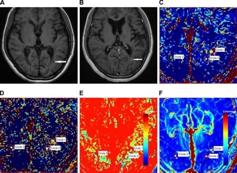 Full Article The Features Of Cerebral Permeability And Perfusion