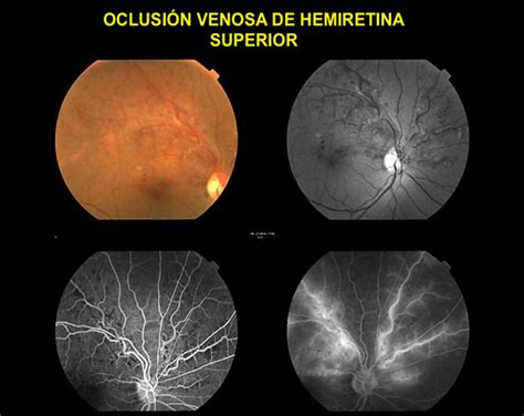 Oclusi N De Vena De La Retina Somos Retina Y M Cula Consultores