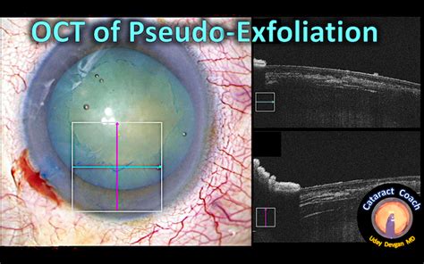 Oct Analysis Of Pseudo Exfoliation Cataracts Cataract Coach™