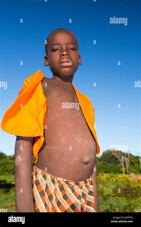 A Malnourished Boy In Malawi Levels Of Child Hunger Are Rising In