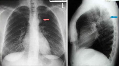 Mediastinum – Toronto Notes