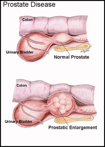 Prostatic Disease Uro Exam Ii Flashcards Quizlet