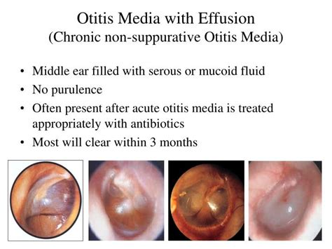 Ppt Chronic Otitis Media Com With And Without Cholesteatoma