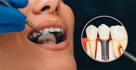 What You Need To Know About Titanium Dental Implants Find Local Dentists