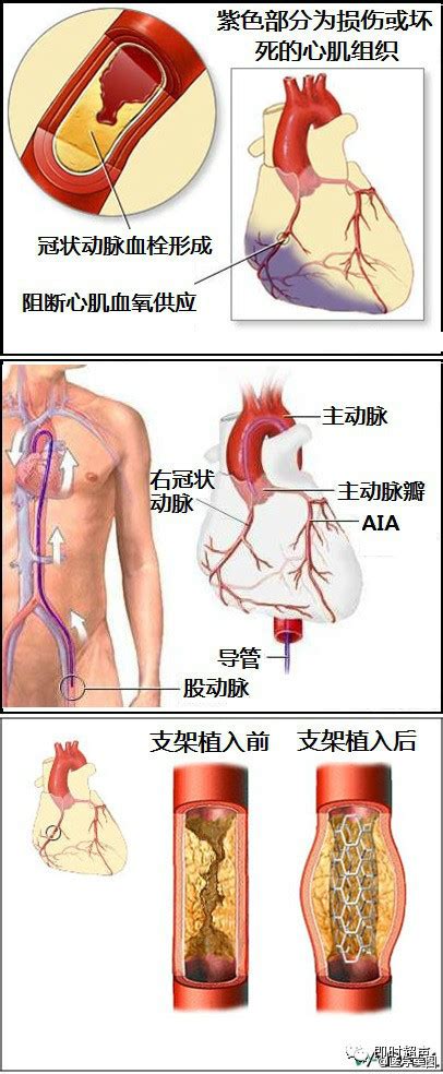 20张图读懂心血管疾病通俗易懂建议收藏 原理 心衰 冠心病 心脏 健康界