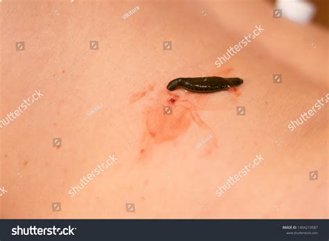 Close Medical Leeches Stuck Human Body Stock Photo 1404210587