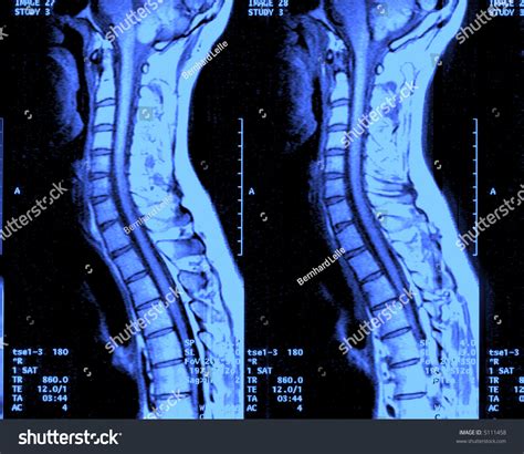 Mri Cervical Spine Stock Photo 5111458 : Shutterstock