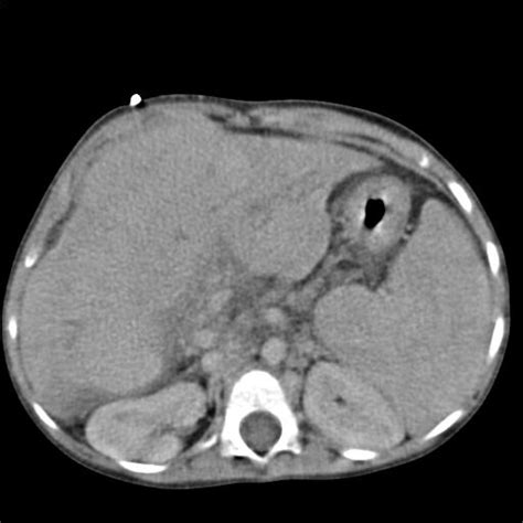 File:CT abdomen - liver cirrhosis - 01.JPG - Wikipedia