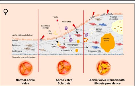 Figure 1 From Sex Specific Features Of Calcific Aortic Valve Disease