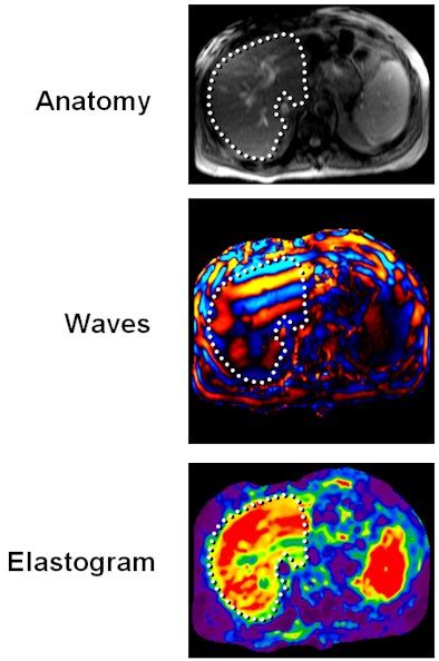 Mayo Clinic develops MR elastography for liver patients | AuntMinnie