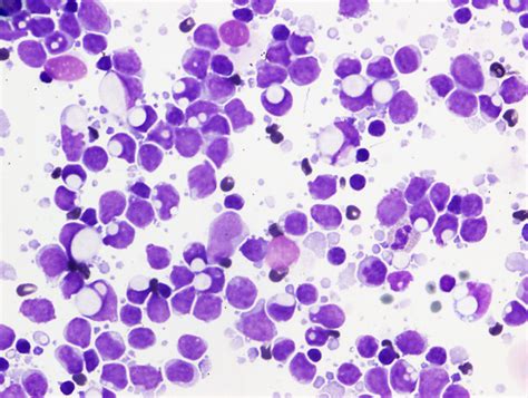 Cancer Cytopathology On Twitter Fna Diagnosis Of Lymphomas With