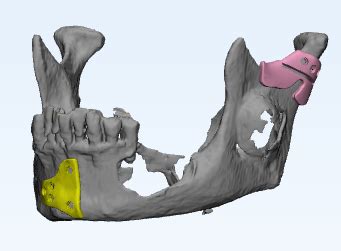 Virtual Surgical Planning For Mandibular Reconstruct And Design Of