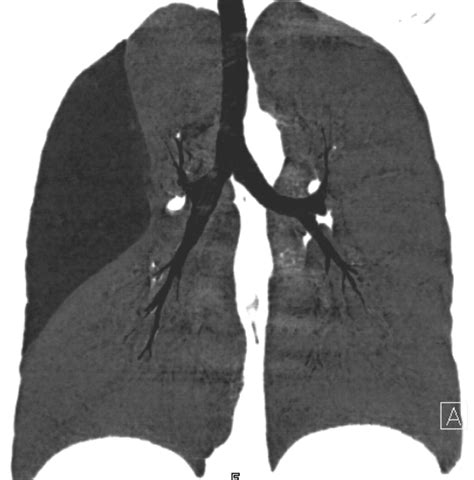 Mdct Demonstration Of Intralobar Pulmonary Sequestration Of The Right