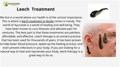 Ppt Leech Treatment In Noida Chauhan Ayurveda Hospital Powerpoint