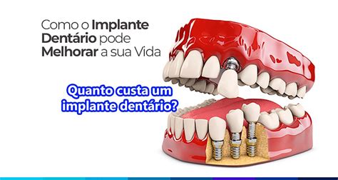 Quanto custa um implante dentário Veja valores reais