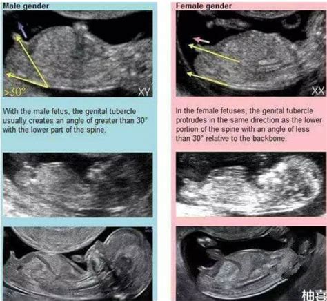 孕12周nt暗示男女方法揭秘，数值大小、nub点可区分 柚喜