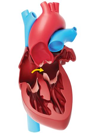 Patent Foramen Ovale Symptoms Stroke Risk Reduction