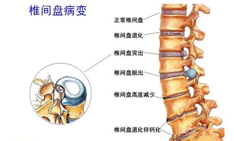 腰椎间盘突出症状表现 44有来医生