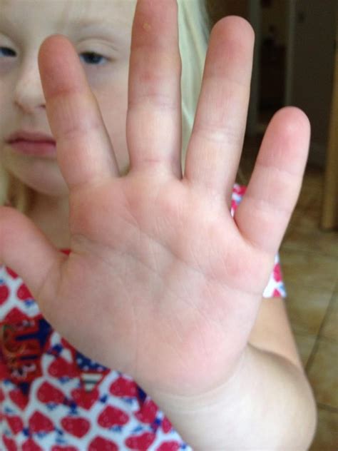 Hands & palmar creases (in children with Down’s syndrome) – Future of Down's