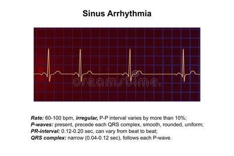 Electrocardiogram Ecg Displaying Sinus Arrhythmia 3d Illustration Stock Illustration