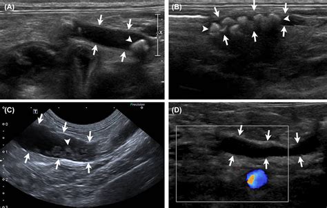 Ultrasound Images Of The Left A And Right B Pancreatic Limbs In A