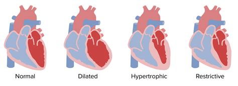 Cardiomyopathy Overview And Types Concise Medical Knowledge