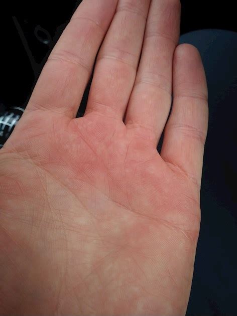 Red Blotches On Hands