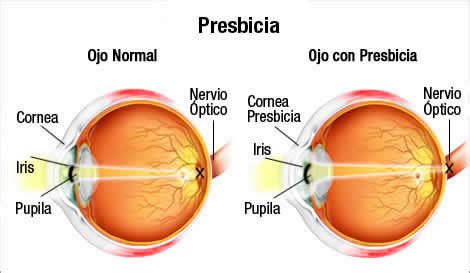 Presbicia Vista Cansada Farmaojos Farmacia Especializada Oftalmolog A